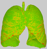 Staircase-Aware Smoothing of Medical Surface Meshes